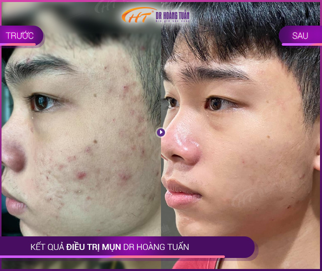 Kết quả trị mụn Thẩm mỹ Hoàng Tuấn